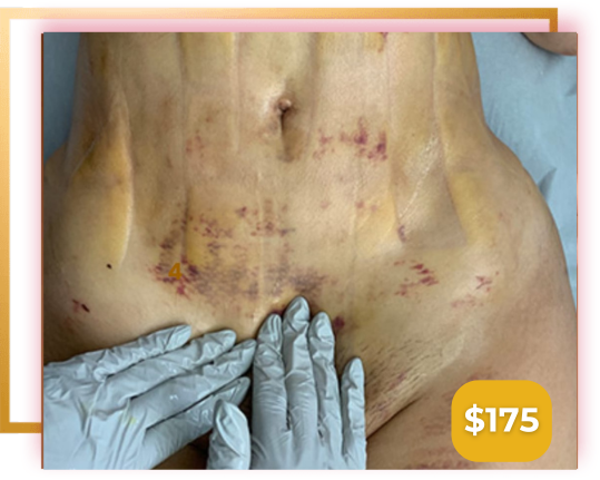Client receiving a manual lymphatic drainage massage during post-surgical recovery