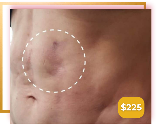 Customised post-surgery recovery treatment combining cavitation, infrared heat and skin tightening