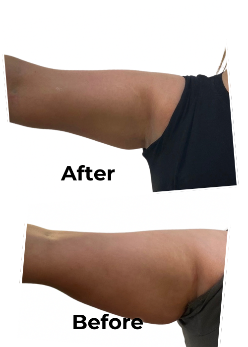 Lemon Bottle Body Small Area Treatment