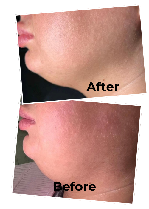 Chin and jawline before Lemon Bottle fat dissolving treatment