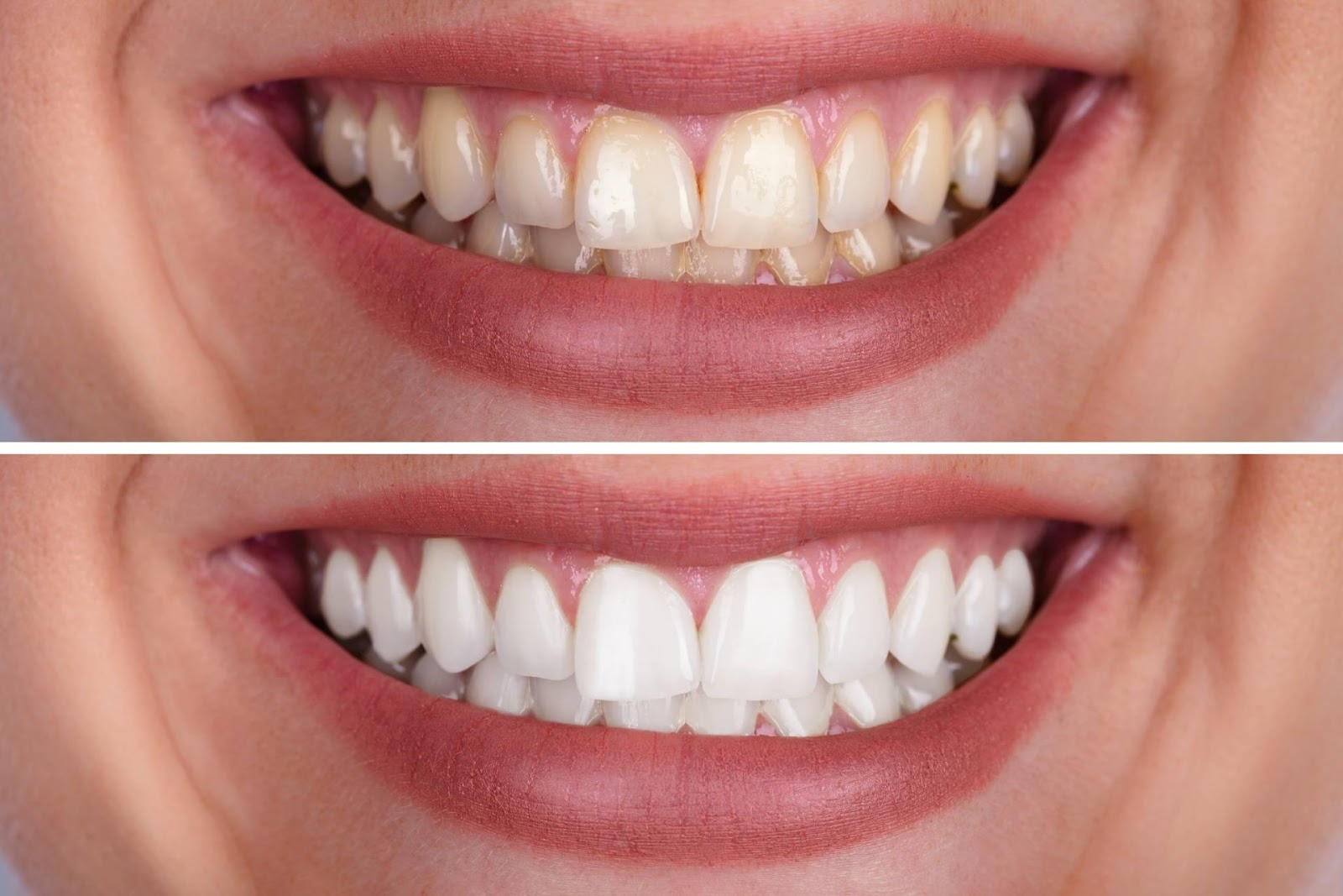 Before and after teeth whitening results